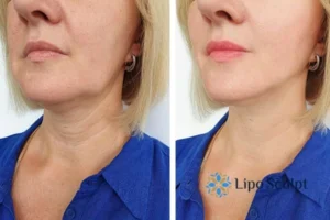 Double chin before and after Hi-Fu treatment 4 Book your double chin treatment Stoke on Trent today! We are here to help!