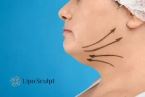 Double chin before and after Hi-Fu treatment 3 Boost your confidence with a Double chin treatment Stoke on Trent