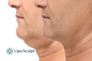 Double chin before and after Hi-Fu treatment 2 Double chin treatment Stoke on Trent from Lipo Sculpt - feel more confident today!