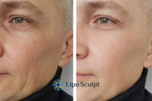 How to Fight Aging Symptoms 3 Fight Aging Symptoms Stoke on Trent With HIFU and Morpheus8 Today!