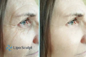 How to Fight Aging Symptoms 2 Do you want to Fight Aging Symptoms Stoke on Trent? Contact Lipo Sculpt today!