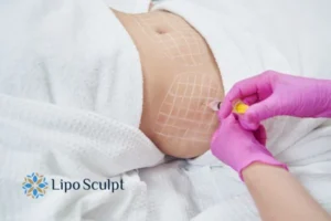 Are The Results From Aqualyx Permanent? 1 Do you want to know how long Aqualyx Stoke on Trent results last?