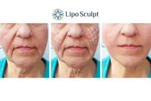 Explaining Morpheus8 And What It Can Do For You 3 Boost your confidence with Morpheus8 Stoke on Trent call our team today!