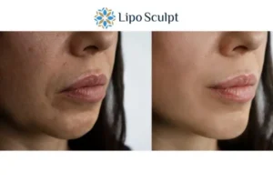 Explaining Morpheus8 And What It Can Do For You 4 Morpheus8 Stoke on Trent the best results - call our team today!