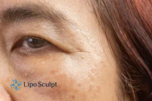 Cryopen: The Revolutionary Treatment for Age Spots Unveiled 2 Are age spots Stoke on Trent giving you low self esteem? Contact us today!