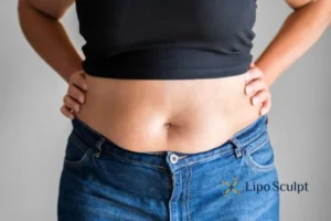 Bidding Farewell to Muffin Tops with Aqualyx Fat Injections 2 Do you wish you could reduce your muffin top Stoke on Trent With Aqualy fat dissolving injections you can!