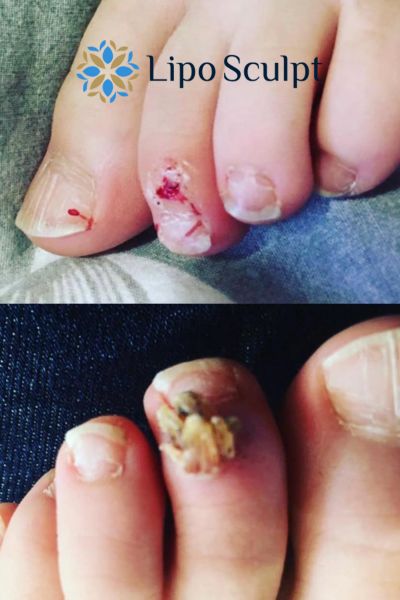 Wart removal customer results from Lipo Sculpt Stoke on Trent
